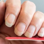 längsrillen fingernägel leber