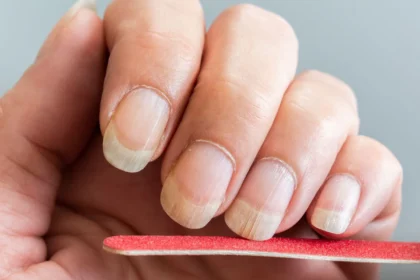 längsrillen fingernägel leber